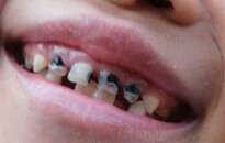 Nemzetközi Gyermekmentő Szolgálat: a hatéves gyermekek csupán 40 százalékának jók a fogai 